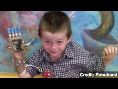 5 Year Old Gets Robotic Hand